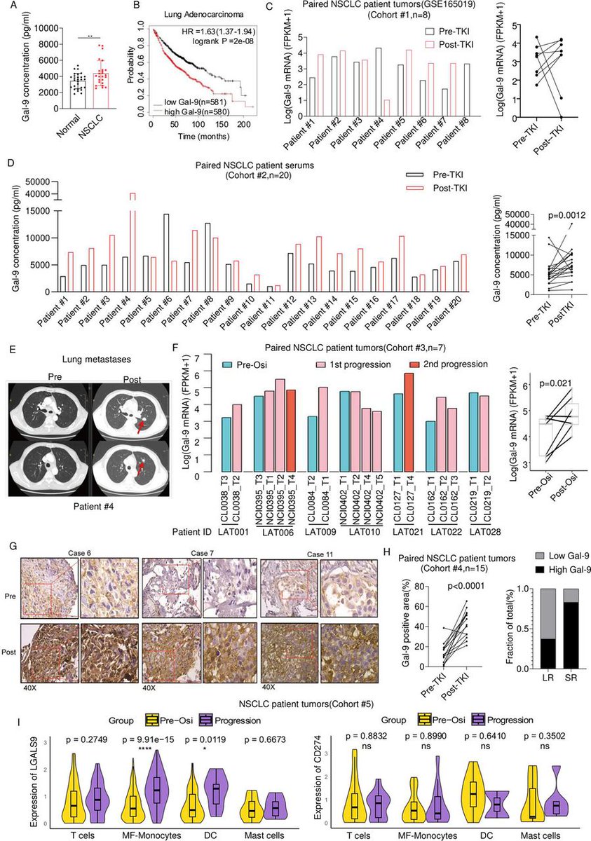 New #JITC article: Anti-galectin-9 therapy synergizes with EGFR inhibition to reprogram the tumor microenvironment and overcome immune evasion bit.ly/4lBt5zj