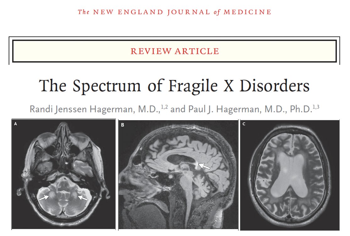 Fragile X isn’t just for kids. How about the adult-onset tremor we frequently blow off? Spoiler alert: Fragile X isn’t one disease, it’s a spectrum. One of its most underrecognized manifestations is a neurological disorder that looks like Parkinson’s or essential tremor, but it’s