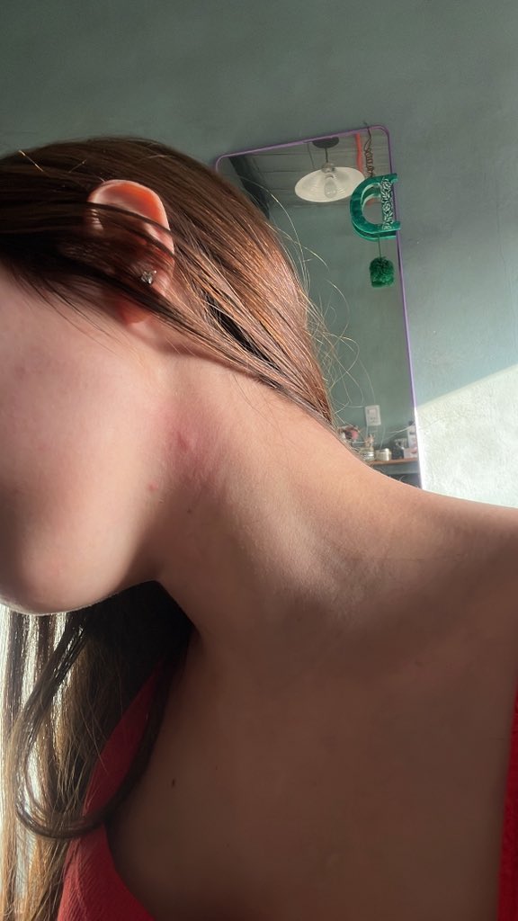 Dafna (@_darkfna) on Twitter photo Hoy en el laburo me dijeron que tenía alto chupon. 
El chupon en cuestión: Hoy en el laburo me dijeron que tenía alto chupon. 
El chupon en cuestión: