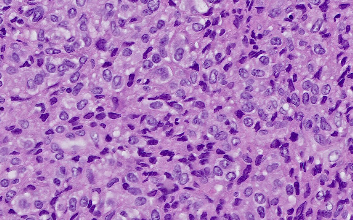 3 yo boy. Past medical history of B-ALL, KMT2A-R at age of one. S/P ASCT. Now presents with a paraspinal mass. Negative stains: CD19, CD79a, CD20, PAX5, TdT, CD3, CD34, CD117, MPO. FISH on fresh tissue shows 100% KMT2A-R. What do you think is happening here? Answer in comments 😉