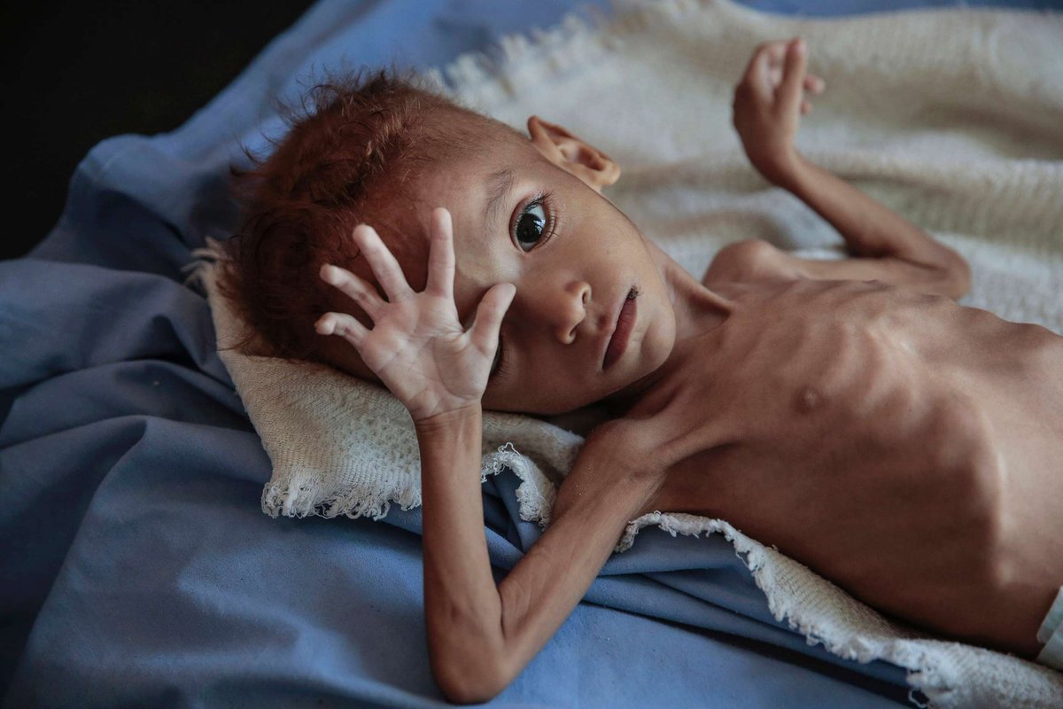 Look at this photo of a starving kid from Gaza.
O, sorry, never mind. This is from Yemen were actual starvation is happening.
But no one cares.
No jews, no news!