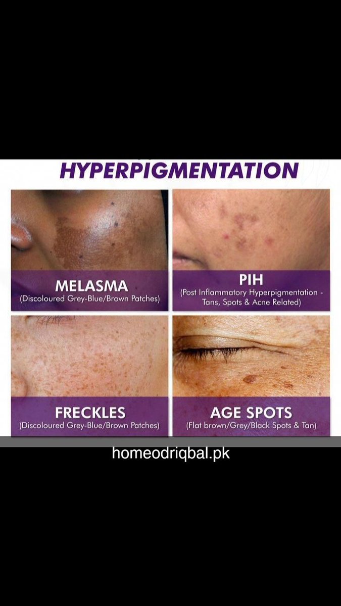 Homeodriqbal's tweet image. 🌈 Types of Hyperpigmentation ✨
🔸 Melasma: Brown/grey patches 🌥️
🔹 PIH: Dark spots after acne 🔥
☀️ Freckles: Sun-triggered brown dots 🌼
🕒 Age Spots: Dark areas from aging 🧓

📍 PH Clinic can help! 💖
#Hyperpigmentation #PHClinic