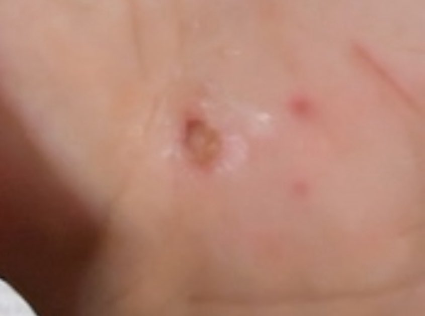 1stmunchk's tweet image. มือเติ้มไปโดนรัยมาเนี่น เป็นแผลใหญ่มั่กก 🥺