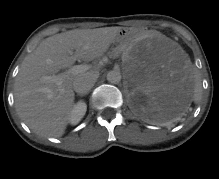 ctisus's tweet photo. Primary Adrenal Carcinoma https://t.co/OAvKw81xfP