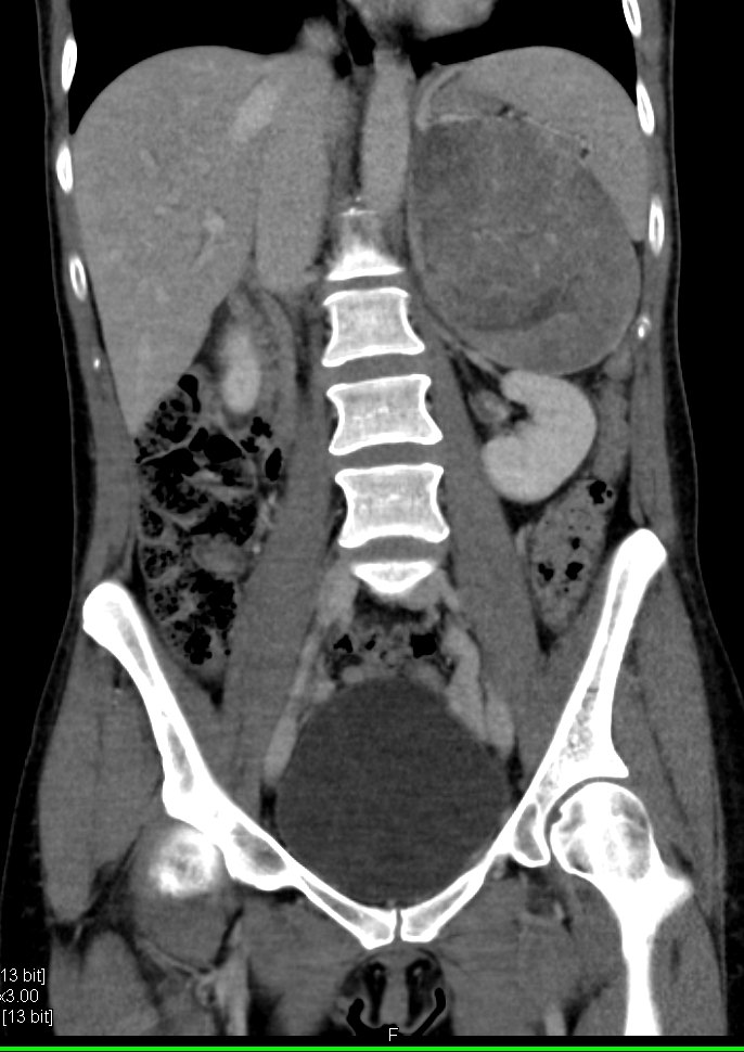 ctisus's tweet photo. Primary Adrenal Carcinoma https://t.co/OAvKw81xfP