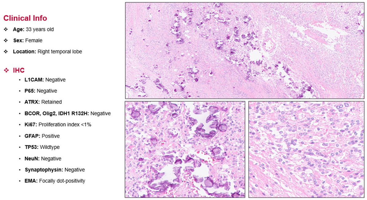 Methylation Case of the Week:  

33 year old female patient with a right temporal lobe lesion. GFAP positive, Olig2 negative, and L1CAM negative. There is a non-Zero chance oF These staining results being unusuAl. #Neuropath #PathTwitter #Pathology