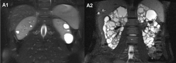 AJKDonline's tweet image. Kidney Cysts in Autosomal Dominant Polycystic Kidney Disease and Alport Syndrome: Two Familial Cases Illustrating Diagnostic Challenges 

bit.ly/Bais25CR 

@RonGansevoort

#ADPKD