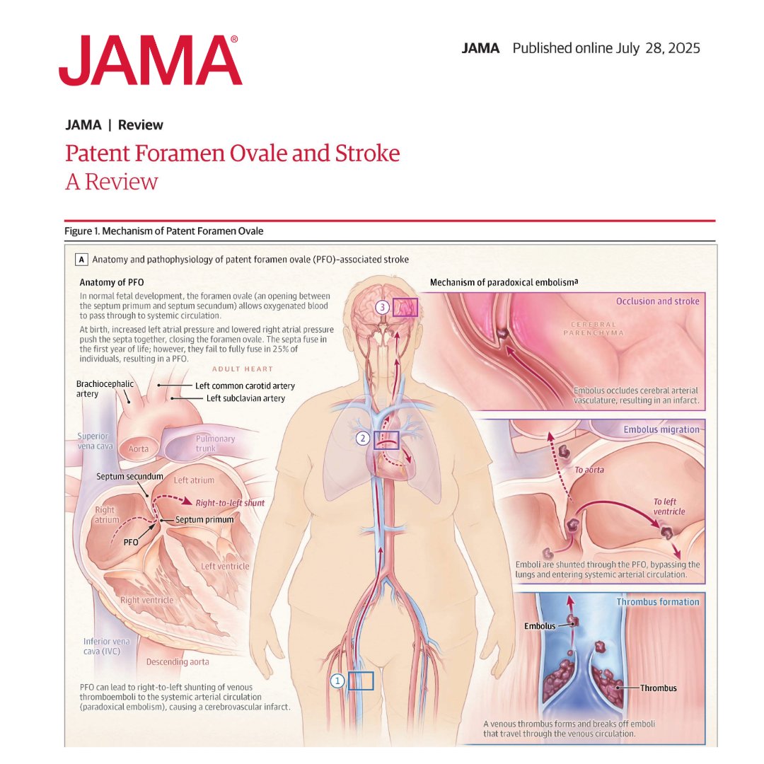 Patent foramen ovale (PFO) is present in approximately 25% of all adults and is a common cause of stroke in young and middle-aged patients. 

This review discusses PFO-associated stroke management. 

ja.ma/4orDOyr