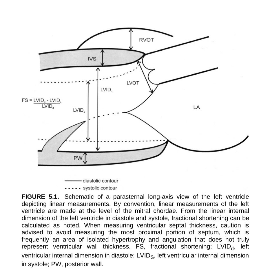 EmergPOCUS's tweet photo. 🫀 Hoy revisamos uno de los planos clásicos del #ecocardiograma el eje largo parasternal! La clave para medir bien 🧪 tu ventrículo izquierdo

📐 ¿Qué se mide aquí? 🤷🏽‍♂️

📏 En el eje largo parasternal, las mediciones #lineales del VI se hacen a nivel de las cuerdas tendinosas mitrales.

🔍 Estas son las estructuras y mediciones principales:
•💆🏽‍♂️ LVIDd: Diámetro interno del VI en diástole
•💪🏽 LVIDs: Diámetro interno del VI en sístole
•➗ FS: Fracción de acortamiento
FS% = (LVIDd - LVIDs) / LVIDd x 100

•🧱 IVS: Tabique interventricular
•🧱 PW: Pared posterior
•🫁 RVOT: Tracto de salida del ventrículo derecho
•🫀 LVOT: Tracto de salida del VI

⚠️ ¡pero ojo!

📌 No midas la porción más proximal del tabique 🧱, ya que suele haber hipertrofia aislada y angulaciones que no reflejan el grosor real de la pared.

🧙🏼 Este plano es básico para estimar función sistólica, valorar hipertrofias y obtener medidas confiables.🫀

#Ecocardio #POCUS #EjeLargo #UltrasonidoC #EchoTips #EchoBasics #FractionalShortening #LVfunction