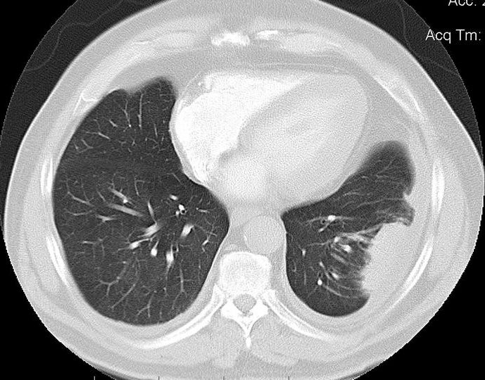 radRounds's tweet image. Benign for malignant in an asymptomatic patient? Differential?