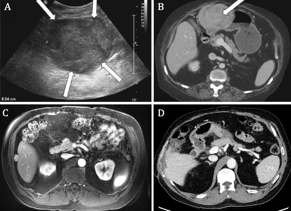 MedBlendPub's tweet image. 🧠 #CaseChallenge
📍 50 y/o male, 4 years post–liver transplant for HCC
🩺 Presents with vague abdominal pain
What's the most likely diagnosis?
Answer 👉 medblendpublishing.com
#Radiology #MedTwitter #RadRes #CT #US #MRI
