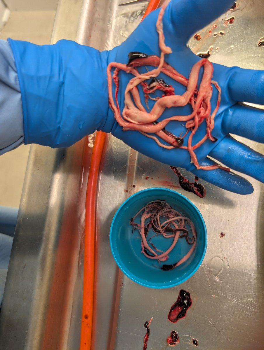 r_hirschman's tweet image. I have been taking a break from X lately. This has been a slower month of work for me, which is kinda nice. However, the clots have not gone away.  This image below is from this month of July 2025. In the cup are clots removed from the femoral artery and vein prior to the…