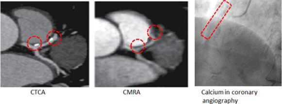 mcpdigital's tweet image. Topological data analysis has emerged as a promising tool in the field of cardiovascular disease, specifically in the assessment of coronary atherosclerosis.
bit.ly/4meiD0D