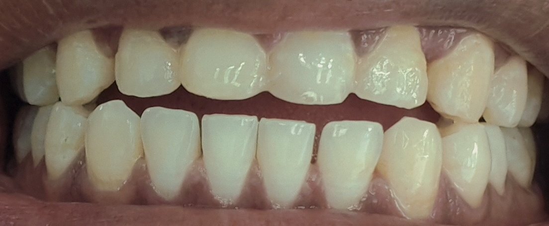 Udayzone909's tweet image. It’s been 524 days since I started my treatment with #Toothsi (#MakeO).
They promised results in 1 year — but I’m back to my original teeth position now they’re covering it up with "booster aligners".
This is a failure. I want my refund.
#ToothsiScam #ConsumerRights #MakeOFailure