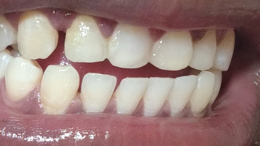 Udayzone909's tweet image. It’s been 524 days since I started my treatment with #Toothsi (#MakeO).
They promised results in 1 year — but I’m back to my original teeth position now they’re covering it up with "booster aligners".
This is a failure. I want my refund.
#ToothsiScam #ConsumerRights #MakeOFailure