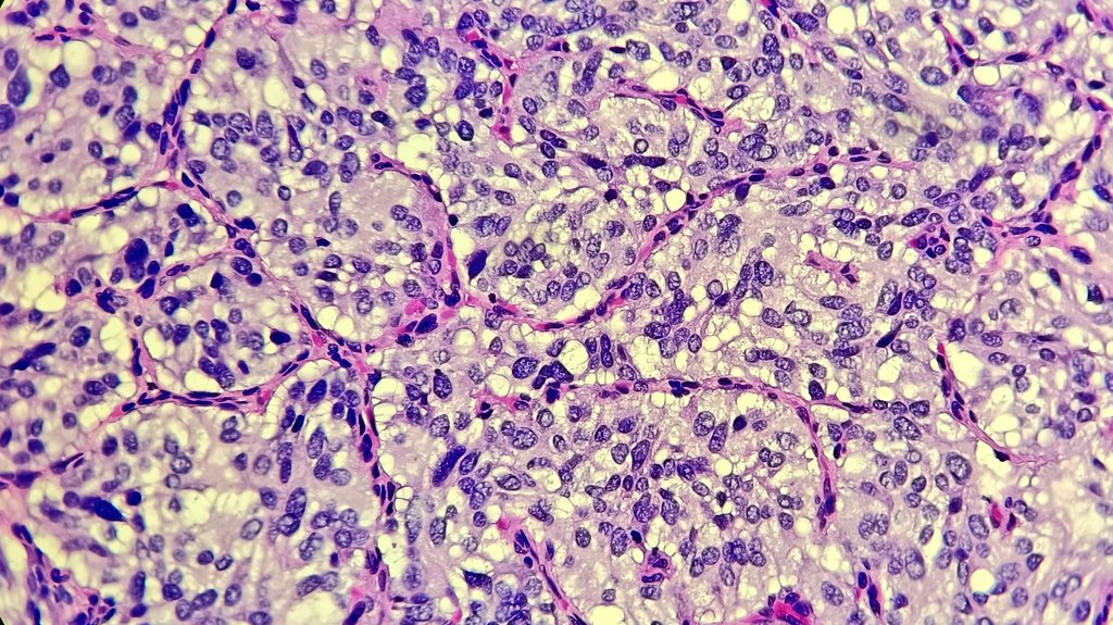 Bladder, 80-year-old, submucosal lesion on cystoscopy #uropath
