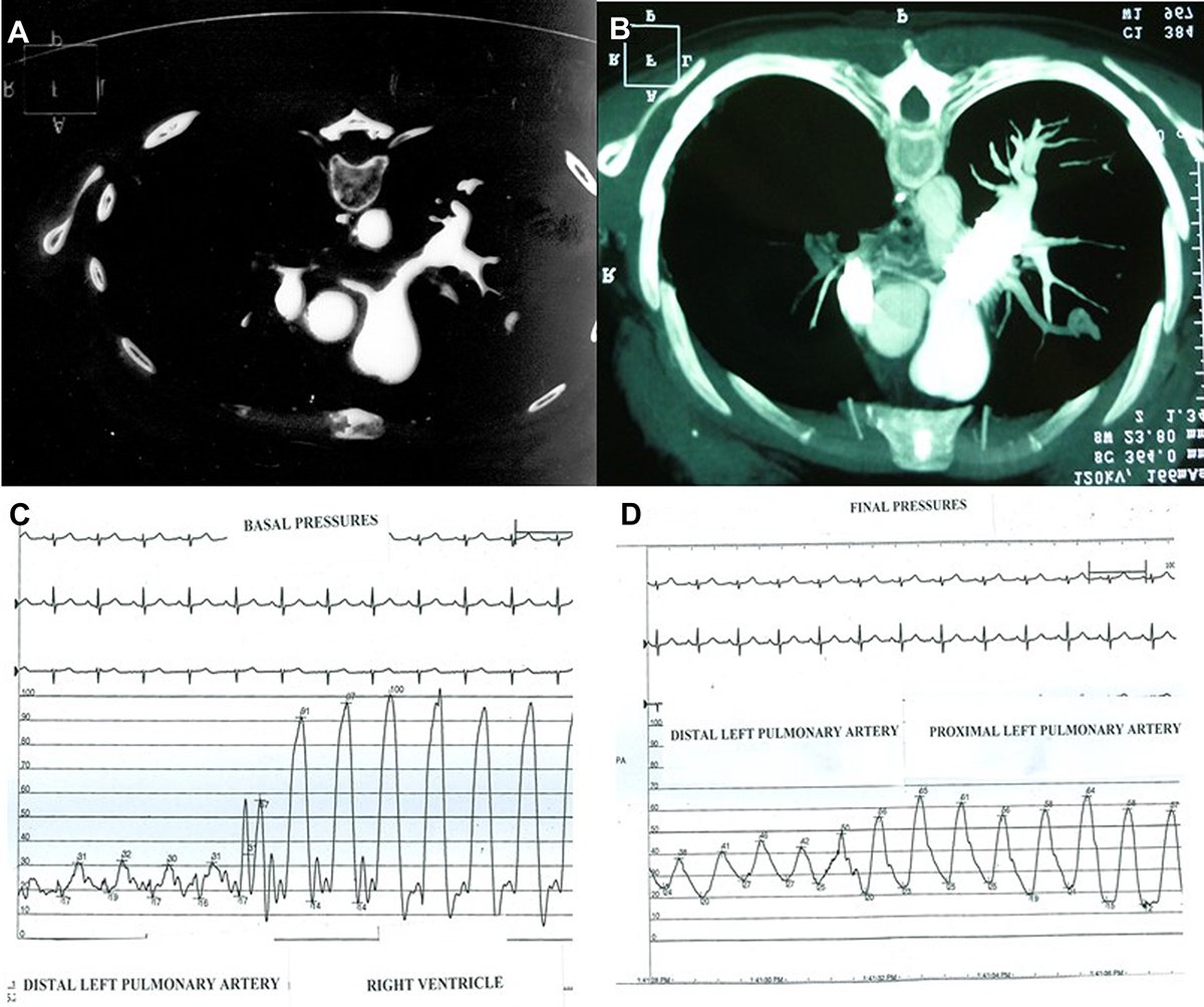 JACCJournals's tweet image. 46F with NYHA III-IV symptoms was diagnosed with PAH 20 years ago and referred for lung transplant. Exam showed central cyanosis and systolic murmurs over carotids, subclavians, and pulmonic area. jacc.org/doi/10.1016/j.… #JACCCaseReports #cvPAH