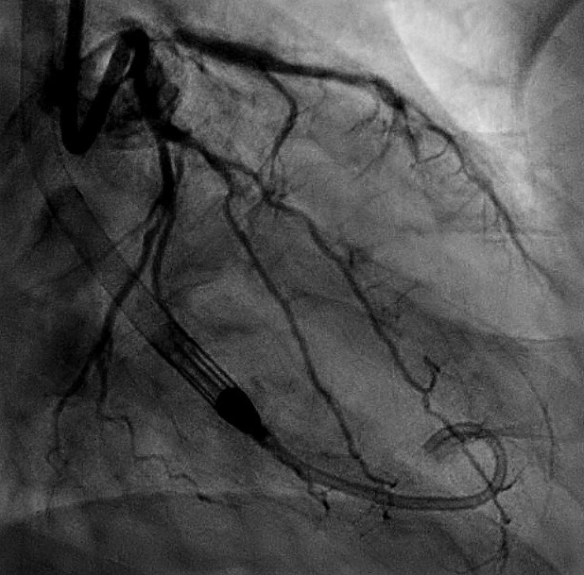 Atul D. Bali, MD tweet media