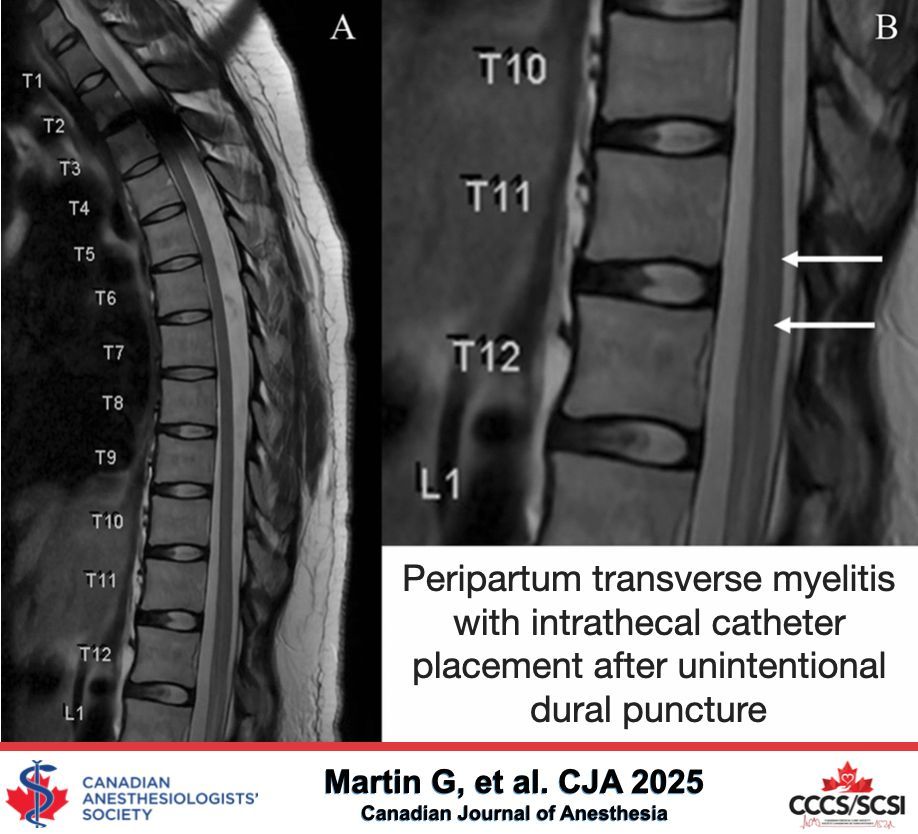 Peripartum transverse myelitis with intrathecal catheter placement after unintentional dural puncture - Canadian Journal of Anesthesia #CJA #Anesthesia #Anesthesiology rdcu.be/euXCX