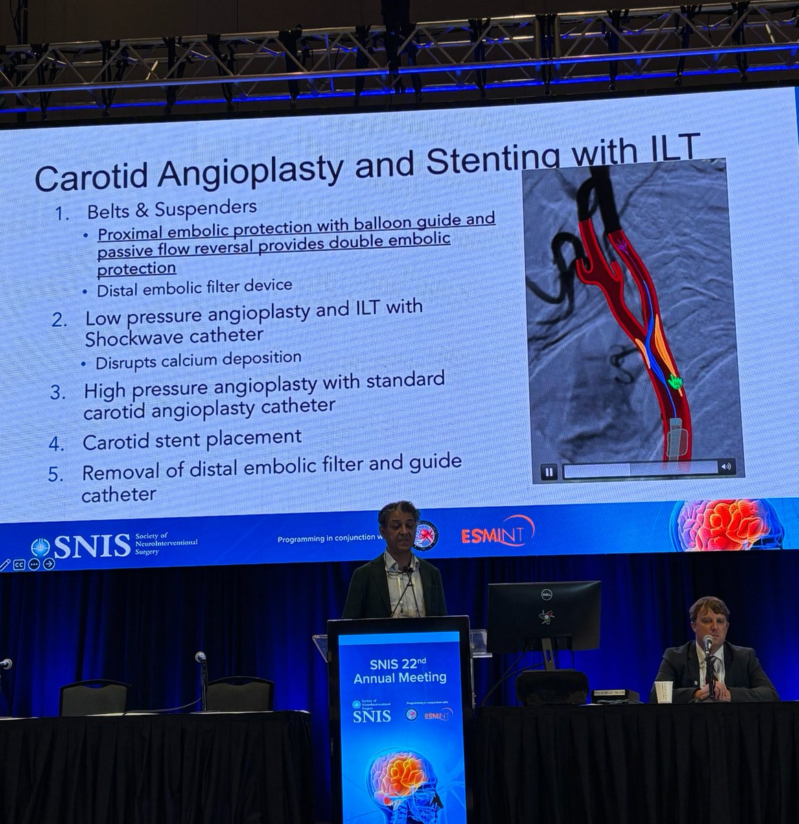 JNIS (@jnis_bmj) on Twitter photo <a href="/_AdnanSiddiqui/">Adnan H. Siddiqui, MD</a> speaking about prevention of strokes during carotid artery stenting. Balloon guide catheter plus distal protection device? #SNIS2025 @SNISInfo <a href="/esmintsociety/">ESMINT Society</a> <a href="/cvsection/">CV Section</a> <a href="/fcalbuquerque51/">Felipe C. Albuquerque</a> <a href="/dr_mchen/">Michael Chen, MD</a> <a href="/DanniDiestro/">Dr. DiestroKE</a> <a href="/MattAmansMD/">Matthew Amans</a> <a href="/ducruetaf/">Andrew Ducruet</a> <a href="/MattFusco_MD/">Matt Fusco</a> <a href="/DrAltschul/">Dorothea Altschul MD FAHA FSVIN</a> <a href="/_AdnanSiddiqui/">Adnan H. Siddiqui, MD</a> speaking about prevention of strokes during carotid artery stenting. Balloon guide catheter plus distal protection device? #SNIS2025 @SNISInfo <a href="/esmintsociety/">ESMINT Society</a> <a href="/cvsection/">CV Section</a> <a href="/fcalbuquerque51/">Felipe C. Albuquerque</a> <a href="/dr_mchen/">Michael Chen, MD</a> <a href="/DanniDiestro/">Dr. DiestroKE</a> <a href="/MattAmansMD/">Matthew Amans</a> <a href="/ducruetaf/">Andrew Ducruet</a> <a href="/MattFusco_MD/">Matt Fusco</a> <a href="/DrAltschul/">Dorothea Altschul MD FAHA FSVIN</a>