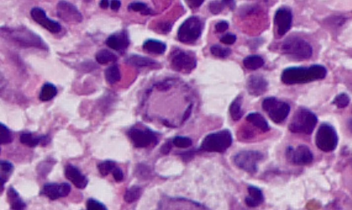 Tiger_heme's tweet image. BMB, 1 yo baby with X linked ichtyosis and anemia. Spot diagnosis ๐ฆฅ