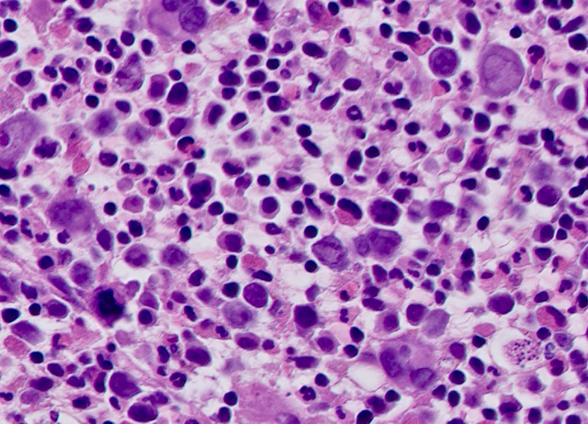 Tiger_heme's tweet image. BMB, 1 yo baby with X linked ichtyosis and anemia. Spot diagnosis ๐ฆฅ