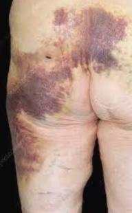 WockyUnits's tweet photo. @dexterzwyfi @BluStripp_ UPDATE: @BluStripp_ has been officially released from the hospital. My team was able to grab a picture of his bum before getting into a 1984 hatchback to depart to his house for recovery. Here is the gruesome picture of what the male did to him. https://t.co/APACwr0ogo