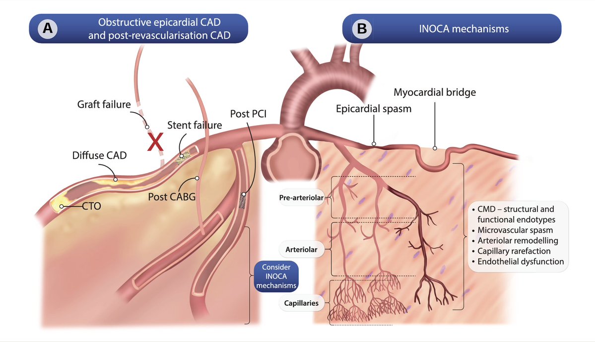 ¿Dr. por qué me duele el pecho si mis arterias están "sanas"?

Buen cuadro sobre los Mecanismos de enfermedad coronaria epicárdica 🆚 INOCA 👌

academic.oup.com/eurheartj/adva…