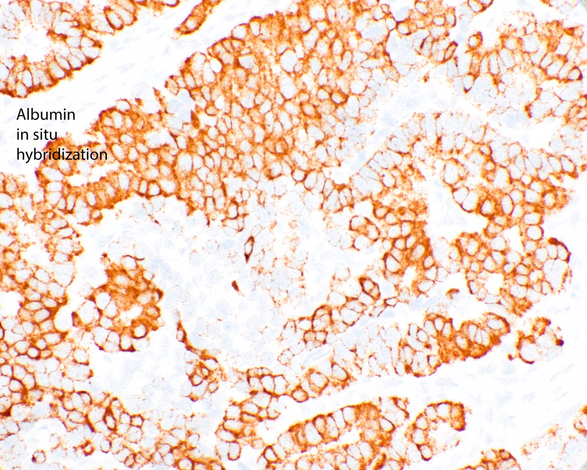 ModernPathology's tweet image. We would wonder where this hepatocellular carcinoma with large nuclei would lie in the model reported this month:
Patil A, Hasan B, Park BU, Smith L, Sivasubramaniam P, Elhalaby R, Elessawy N, Nazli S, DaCosta A, Shabaan A, Cannon A, Lau C, Hartley CP, Graham RP, Moreira RK. A…