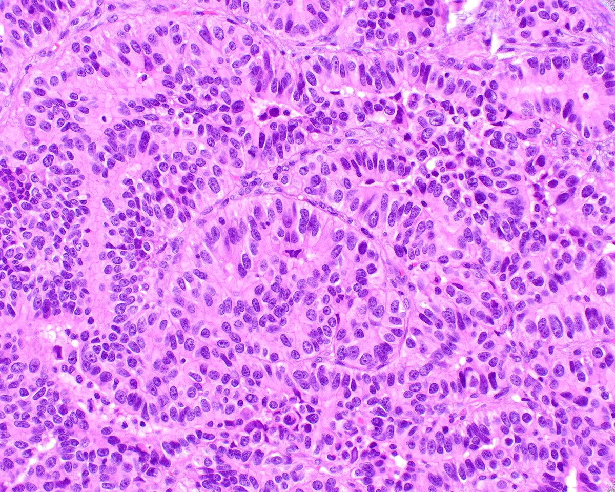 ModernPathology's tweet image. We would wonder where this hepatocellular carcinoma with large nuclei would lie in the model reported this month:
Patil A, Hasan B, Park BU, Smith L, Sivasubramaniam P, Elhalaby R, Elessawy N, Nazli S, DaCosta A, Shabaan A, Cannon A, Lau C, Hartley CP, Graham RP, Moreira RK. A…