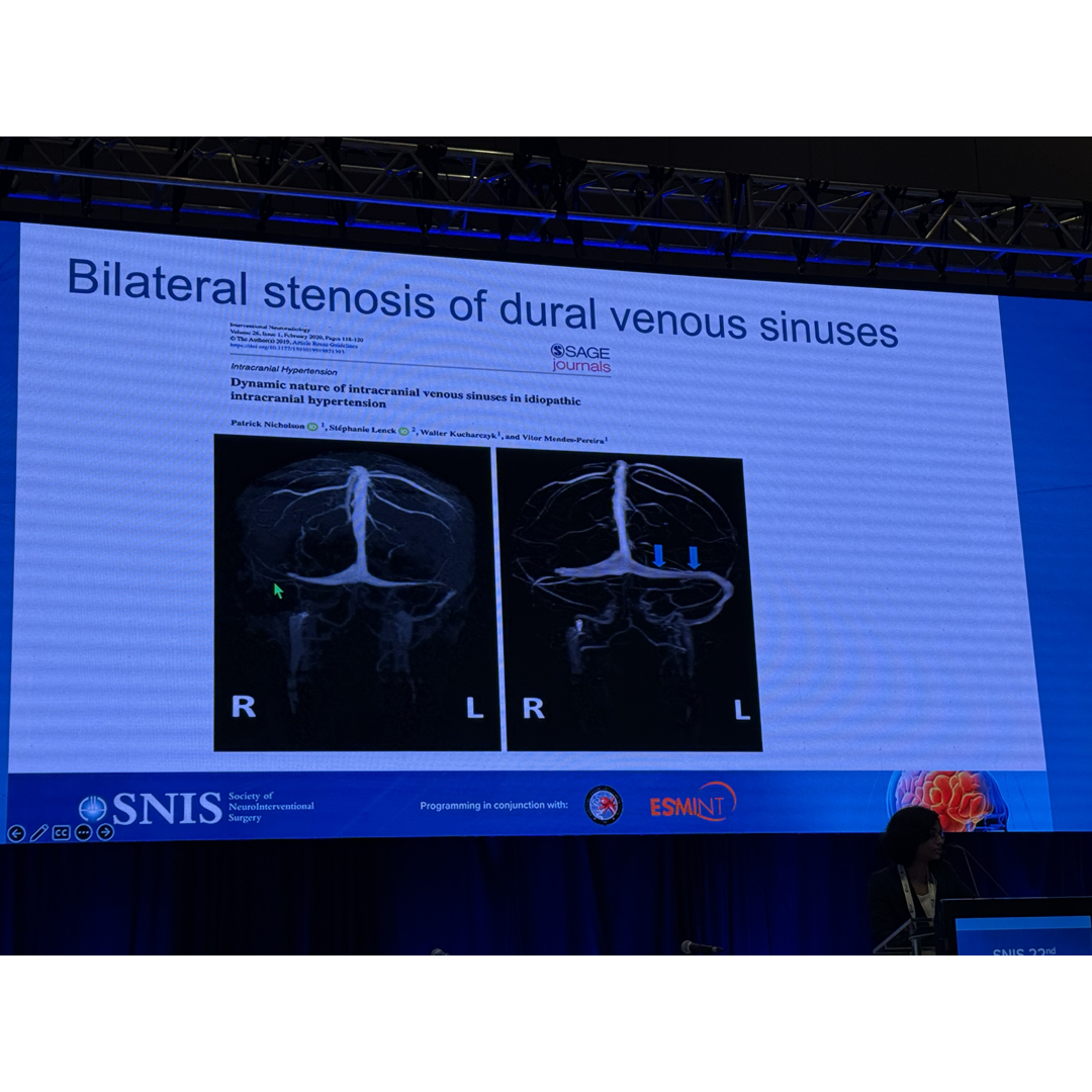 JNIS_BMJ's tweet image. What’s better than unilateral Venous Sinus Stenosis Stenting (VSSS)? BILATERAL VENOUS STENTS!! Learn from Dr. Roy about their single center experience Ballroom A #SNIS2025
@SNISinfo @esmintsociety @cvsection @fcalbuquerque51 @dr_mchen @dannidiestro @MattAmansMD @ducruetaf…