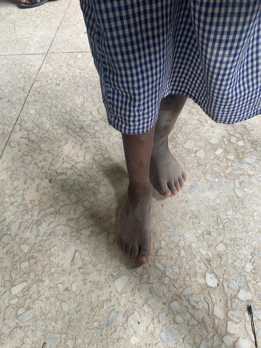 profUNILORIN's tweet image. This is the leg of a student
No shows,no socks , but with a dream
A dream of going to school,no matter the situation.
Let's stop this leg from hurting and scaring.
Donate a pair of socks or shoes now to prove that Education doesn't end with your disability or Inadequacy.