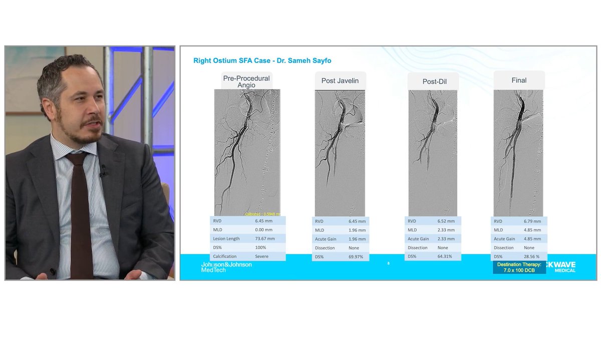 ShockwaveIVL's tweet image. In a complex right ostial SFA case, Dr @Samsayfo walks through his approach with Dr @KaranGargMD, demonstrating the effectiveness of #ShockwaveJavelin in difficult lesions. See full case: hmpgloballearningnetwork.com/site/vdm/shock…
US Rx only. ISI bit.ly/3iEq7fC