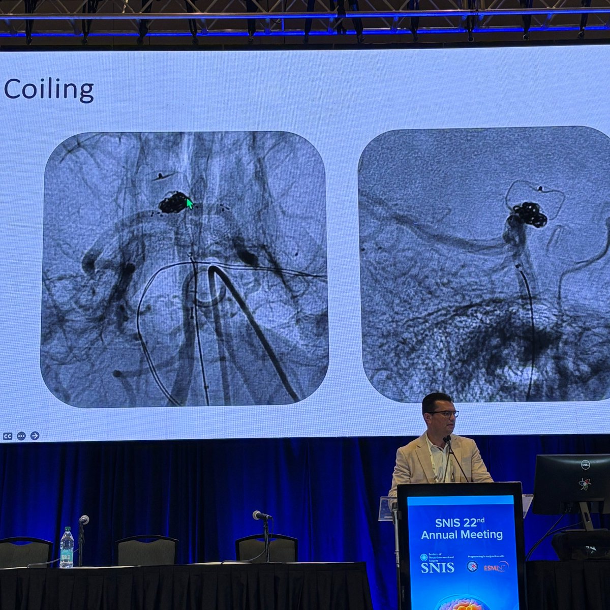 JNIS (@jnis_bmj) on Twitter photo <a href="/vitorpereiracan/">Vitor Mendes Pereira</a> discussing pCONUS and eCLIPs. May be useful after residuals with intrasaccular devices. #SNIS2025 @SNISInfo <a href="/esmintsociety/">ESMINT Society</a> <a href="/cvsection/">CV Section</a> <a href="/fcalbuquerque51/">Felipe C. Albuquerque</a> <a href="/dr_mchen/">Michael Chen, MD</a> <a href="/DanniDiestro/">Dr. DiestroKE</a> <a href="/MattAmansMD/">Matthew Amans</a> <a href="/ducruetaf/">Andrew Ducruet</a> <a href="/MattFusco_MD/">Matt Fusco</a> <a href="/DrAltschul/">Dorothea Altschul MD FAHA FSVIN</a> @cruzcerebri <a href="/niko_mou/">Niko Mouchtouris, MD</a> <a href="/vitorpereiracan/">Vitor Mendes Pereira</a> discussing pCONUS and eCLIPs. May be useful after residuals with intrasaccular devices. #SNIS2025 @SNISInfo <a href="/esmintsociety/">ESMINT Society</a> <a href="/cvsection/">CV Section</a> <a href="/fcalbuquerque51/">Felipe C. Albuquerque</a> <a href="/dr_mchen/">Michael Chen, MD</a> <a href="/DanniDiestro/">Dr. DiestroKE</a> <a href="/MattAmansMD/">Matthew Amans</a> <a href="/ducruetaf/">Andrew Ducruet</a> <a href="/MattFusco_MD/">Matt Fusco</a> <a href="/DrAltschul/">Dorothea Altschul MD FAHA FSVIN</a> @cruzcerebri <a href="/niko_mou/">Niko Mouchtouris, MD</a>