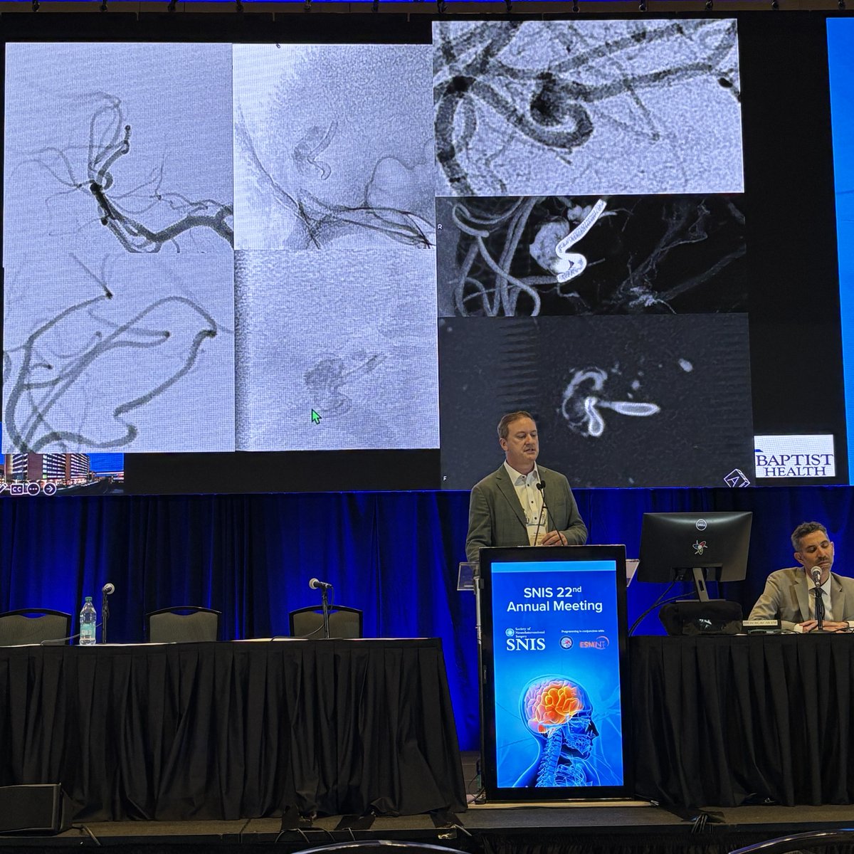 JNIS_BMJ's tweet image. Dr. Ricardo Hanel showing data for the Silk Vista Baby! Great tool for distal aneurysms that need flow diversion. #SNIS2025 @SNISInfo @esmintsociety @cvsection @fcalbuquerque51 @dr_mchen @DanniDiestro @MattAmansMD @ducruetaf @MattFusco_MD @DrAltschul @cruzcerebri @niko_mou…