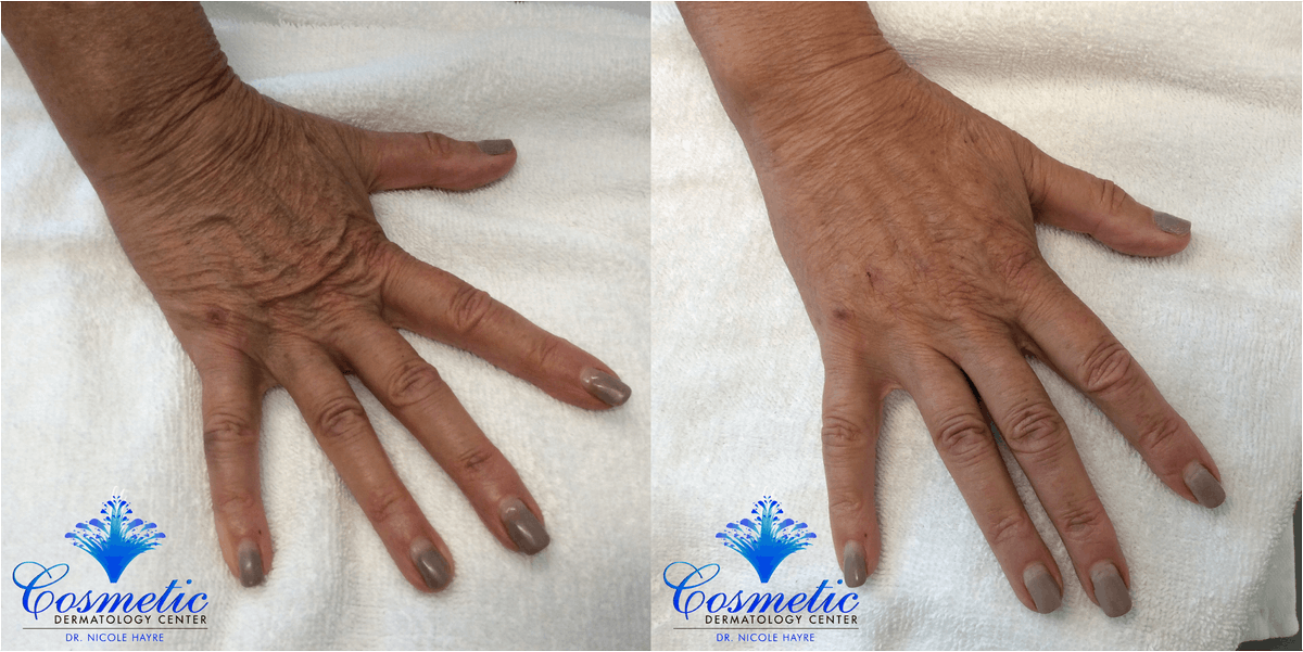 CosDermCenter's tweet photo. 💉✨ Turn back time — starting with your hands.
Veins, volume loss, crepey skin? Smoothed in minutes.

📸 Check the transformation.
⏳ Lasts 12–18 months.
DM to book!

#HandFiller #YouthfulHands #BeforeAndAfter #McLeanVA #AestheticMedicine #DMVAesthetics https://t.co/FSgKm02bLG