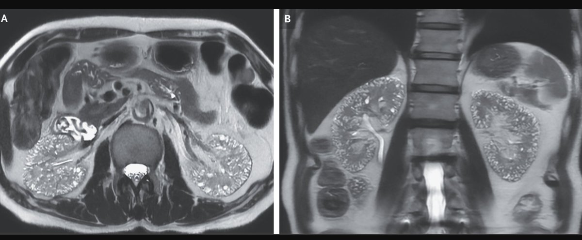 Microcysts in Lithium-Induced Nephropathy nejm.org/doi/full/10.10…