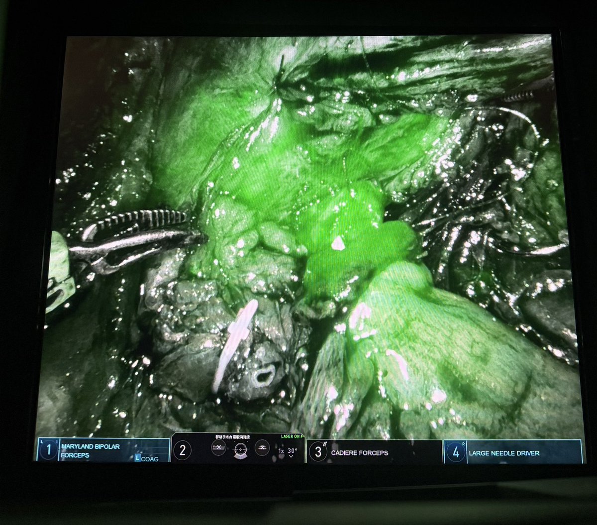 Totally intracorporeal robotic left ileal ureter for left solitary kidney with UTUC.
