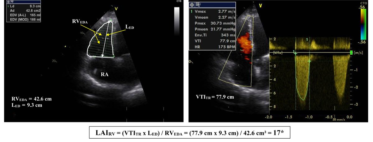 SusieSu11733465's tweet image. 🥳Welcome to read Dr. Michael Dandel's Review - "Load Dependency of #Ventricular Pump #Function: Impact on the Non-Invasive Evaluation of the Severity and the Prognostic Relevance of #Myocardial #Dysfunction"

⚡️Full Text: imrpress.com/journal/RCM/25…