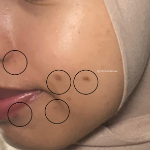 rohmatulizzaa's tweet photo. Mau sungkem dulu sama serum satu ini 🙇‍♀️—bekas jerawat &amp; bekas kecipratan minyakku berhasil memudar!! Baru kali ini nemu yang beneran works di kulitku! 💆‍♀️ #izzareviews

Before                                                         After https://t.co/rvFuLz18Po