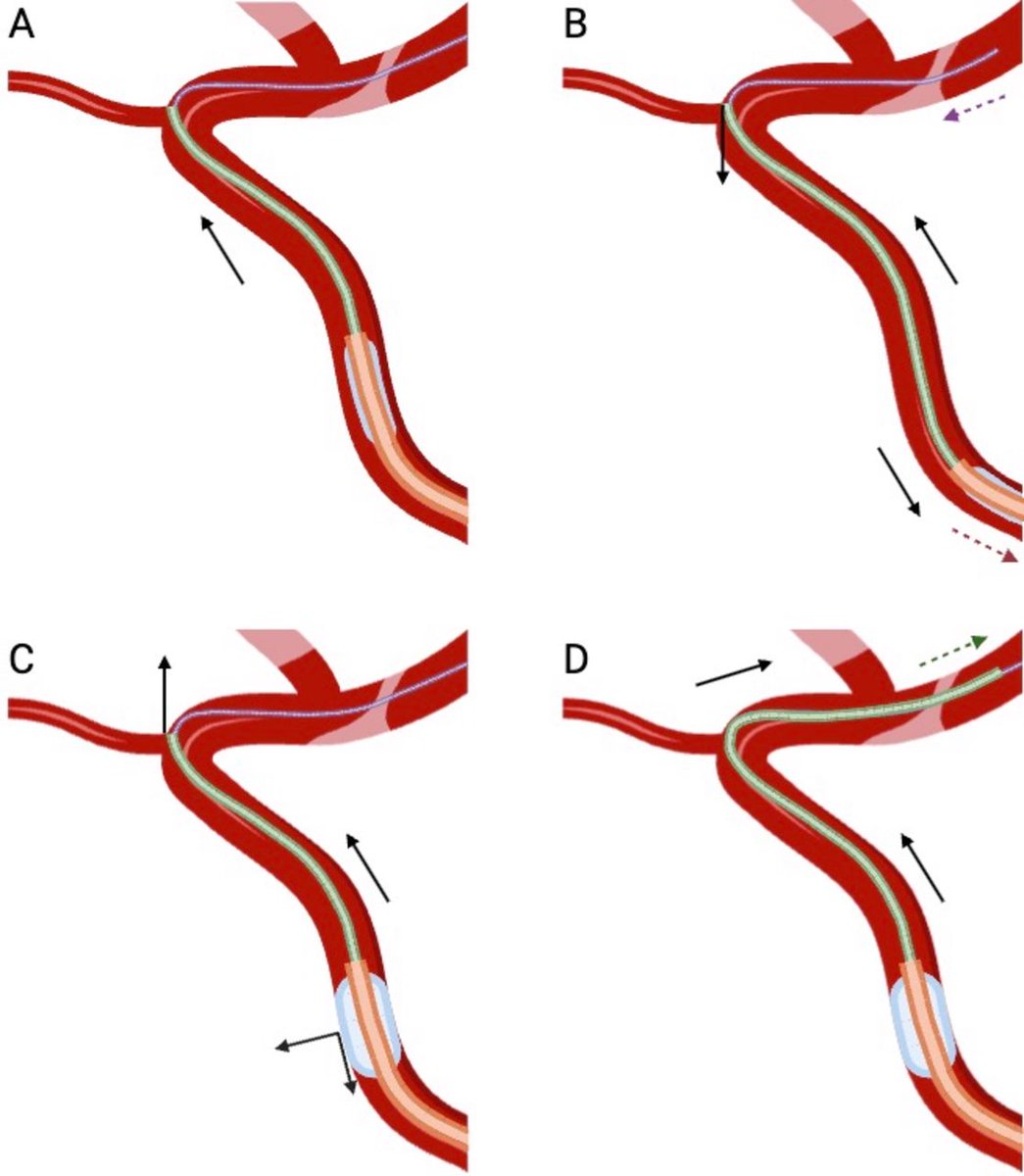 Visish M. Srinivasan, MD (@visishs) on Twitter photo What can you do when you run to a tough ledge on a thrombectomy? What about when wire access into the CCA is proving difficult? You can turn to your trusty balloon guide catheter of course!
<a href="/albertqzwu/">Albert Q. Wu</a> put together the <a href="/PennNSG/">Penn Neurosurgery</a> experience
w/ the "Slingshot" technique <a href="/JNIS_BMJ/">JNIS</a> What can you do when you run to a tough ledge on a thrombectomy? What about when wire access into the CCA is proving difficult? You can turn to your trusty balloon guide catheter of course!
<a href="/albertqzwu/">Albert Q. Wu</a> put together the <a href="/PennNSG/">Penn Neurosurgery</a> experience
w/ the "Slingshot" technique <a href="/JNIS_BMJ/">JNIS</a>
