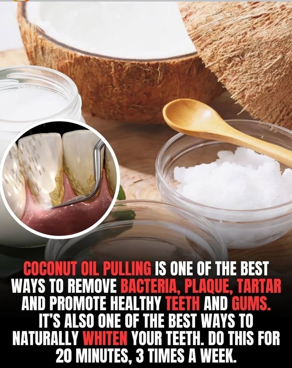 BarbaraOneillAU's tweet photo. Oil pulling with coconut oil is a time-tested Ayurvedic practice that helps eliminate harmful oral bacteria, reduce plaque buildup, and support healthier gums. Rich in antimicrobial compounds like lauric acid, coconut oil has been shown to combat Streptococcus mutans, one of the primary bacteria responsible for tooth decay and gum disease.

Clinical studies have found that oil pulling can significantly decrease plaque and gingivitis when practiced regularly. It also acts as a natural teeth whitener by gently removing surface stains without damaging enamel.

How to do it:
👉Swish 1 tablespoon of organic coconut oil in your mouth for 15-20 minutes
👉Spit it into a trash can (not the sink)
👉Rinse with warm water and brush as usual
👉Repeat 3-7times a week for best results

Consistent practice can lead to fresher breath, whiter teeth, and stronger oral defenses - all without chemicals or synthetic ingredients.

Natural. Effective. Backed by tradition and emerging science.