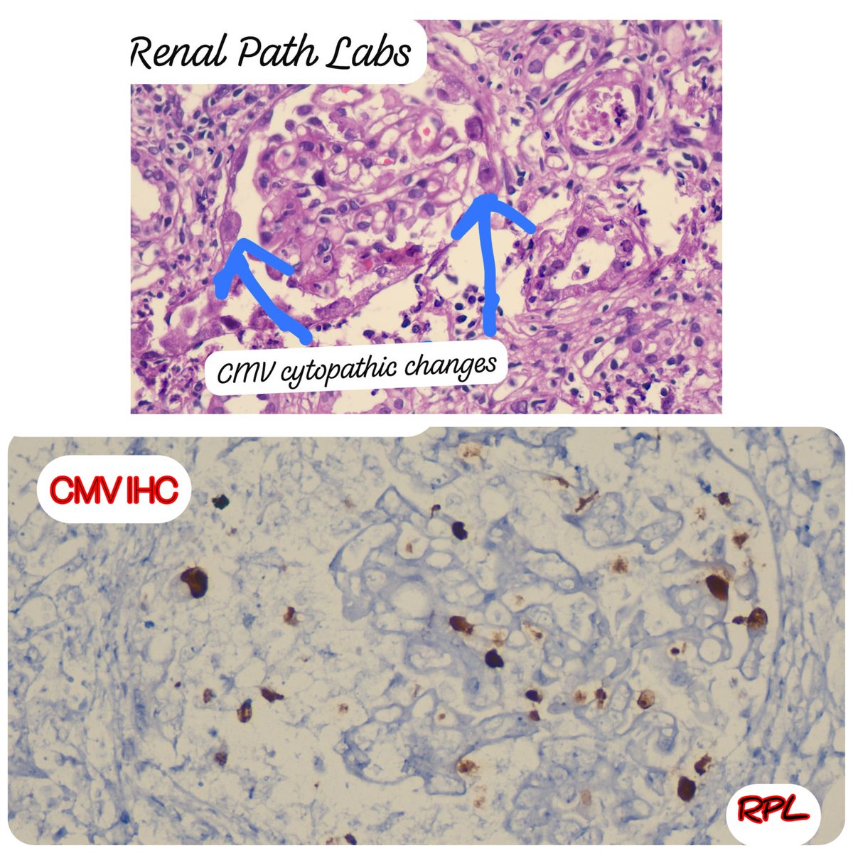 RenalPathLabs's tweet image. Potpourri of Post Tx infections!!
CMV, BKV, Mucor &Candida!!
Add images of infections you come across, in comments!!
#RenalBiopsy #NephTwitter #PathTwitter #RenalPathSociety #AskRenal #ISRTP #RenalPathLabsGurugram #PostTxInfections #PoojaMaheshwari