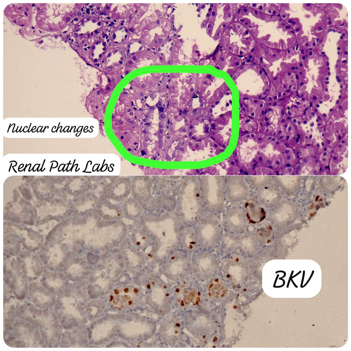 RenalPathLabs's tweet image. Potpourri of Post Tx infections!!
CMV, BKV, Mucor &Candida!!
Add images of infections you come across, in comments!!
#RenalBiopsy #NephTwitter #PathTwitter #RenalPathSociety #AskRenal #ISRTP #RenalPathLabsGurugram #PostTxInfections #PoojaMaheshwari