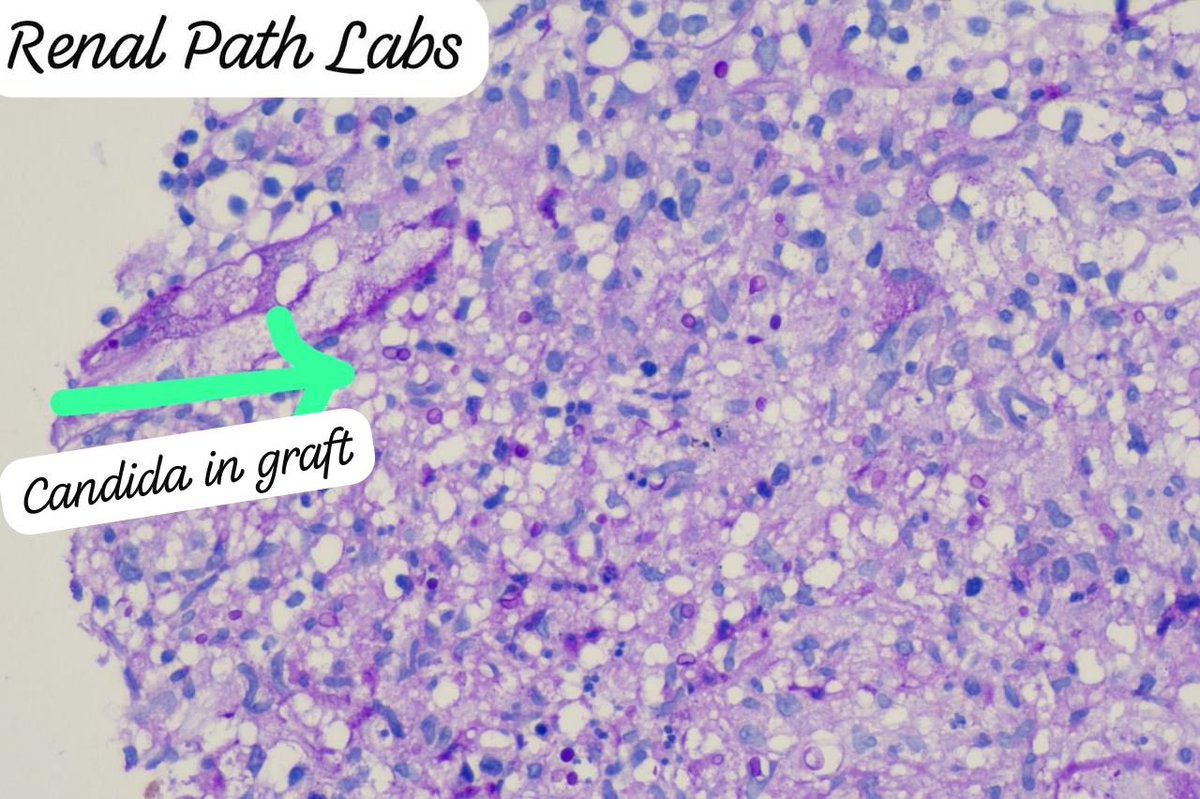 RenalPathLabs's tweet image. Potpourri of Post Tx infections!!
CMV, BKV, Mucor &Candida!!
Add images of infections you come across, in comments!!
#RenalBiopsy #NephTwitter #PathTwitter #RenalPathSociety #AskRenal #ISRTP #RenalPathLabsGurugram #PostTxInfections #PoojaMaheshwari