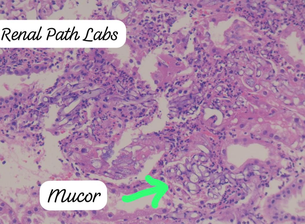 RenalPathLabs's tweet image. Potpourri of Post Tx infections!!
CMV, BKV, Mucor &Candida!!
Add images of infections you come across, in comments!!
#RenalBiopsy #NephTwitter #PathTwitter #RenalPathSociety #AskRenal #ISRTP #RenalPathLabsGurugram #PostTxInfections #PoojaMaheshwari