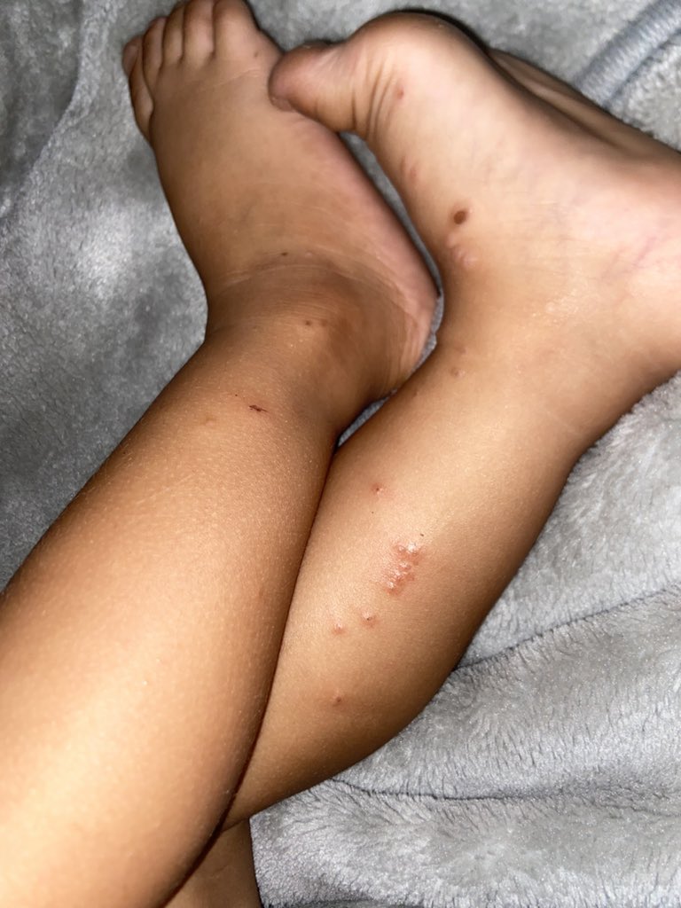 SQadih18061's tweet image. This is my beautiful child, how was he and how did he complain of love in his foot and hurt him? Please help me buy his treatment in the paper.
gofund.me/4622c497
x.com/aechoire?s=11