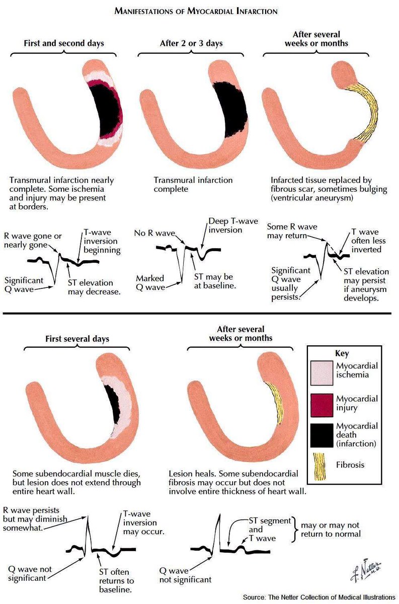 DrJayMohan's tweet image. What is a STEMI (MYOCARDIAL INFARCTION) ❓
✅In current practice, ST-segment elevation at the J-point, ≥1 mm in ≥2 adjacent leads (other than leads V2 and V3, where elevation of ≥2 mm in men or ≥1.5 mm in women is considered significant) or a new LBBB is commonly used for…