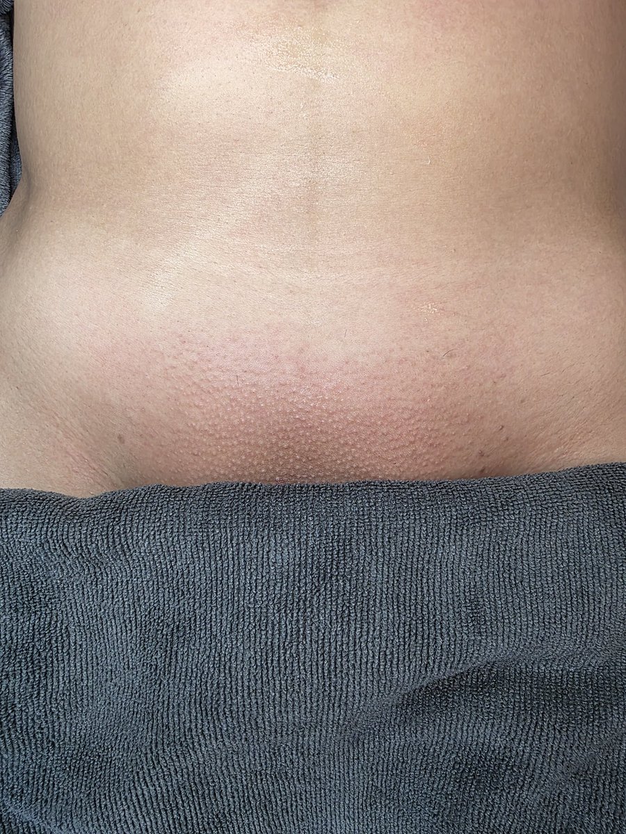 깔끔한 브라질리언 왁싱✨️
<a href="/KH40824448/">켈로그</a>

✓ 남자 원장님의 1:1 맞춤 예약 관리
✓ 시술 후 모든 기구, 용품 소독 및 1회 용품 사용
✓ 샤워실 완비

문의 : open.kakao.com/o/sXF03Mzf

#인천남자왁싱 #남자왁서 #인하대 #부평 #주안