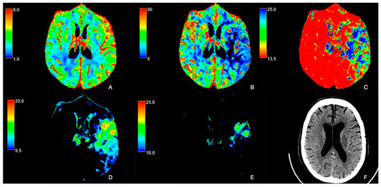 🚨 New study explores the impact of premorbid statin use on CT perfusion imaging in acute ischemic stroke patients. Could early treatment improve outcomes? 🧠🩻

🔗 brnw.ch/21wUcUb
#Stroke #CTPerfusion #Neuroimaging #Tomography